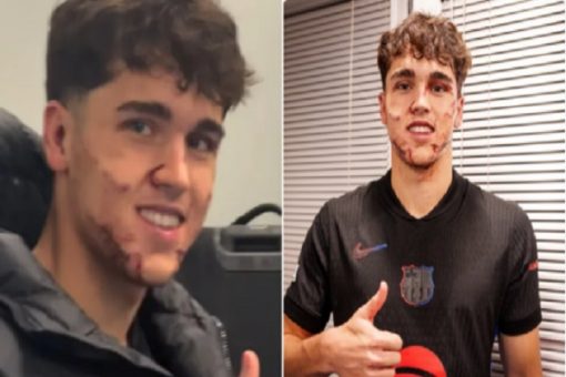 Barcelona’s Cubarsi Receives 10 Stitches After Painful Kick to Face in Champions League Victory